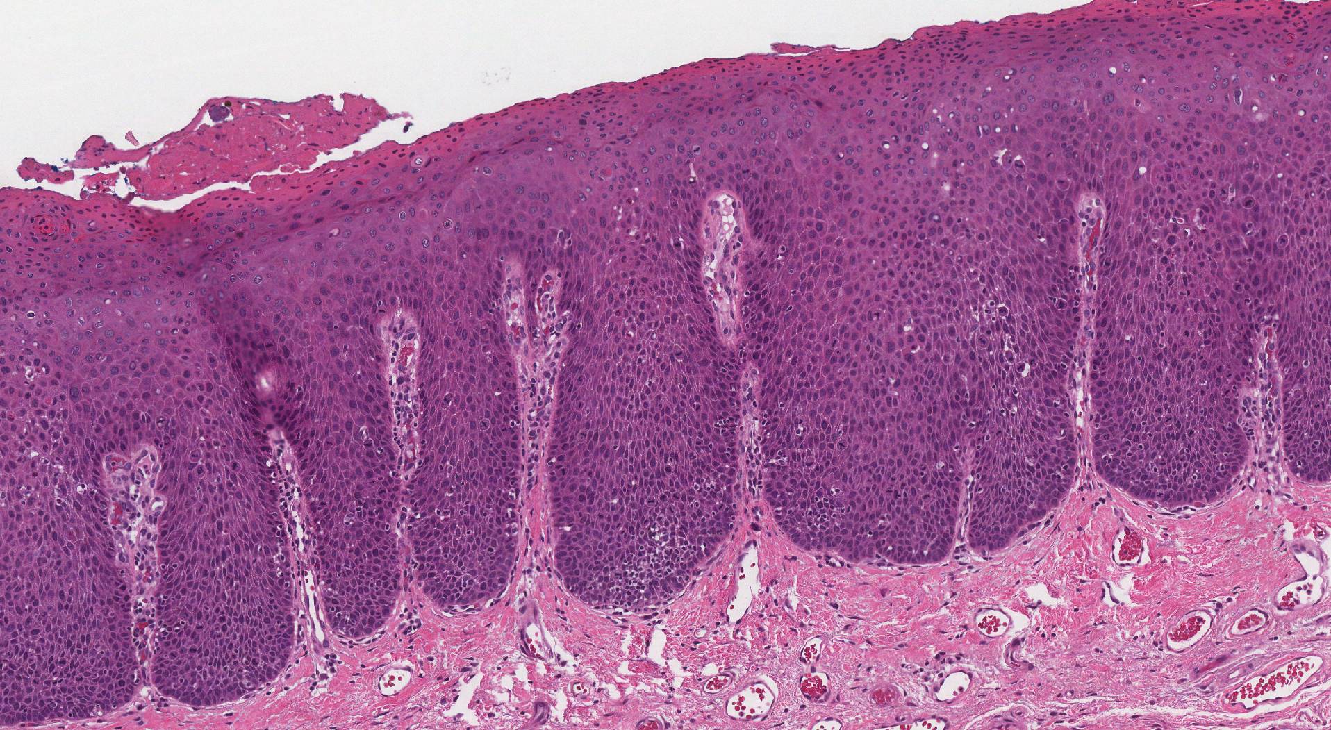 HPV associated squamous dysplasia oral cavity