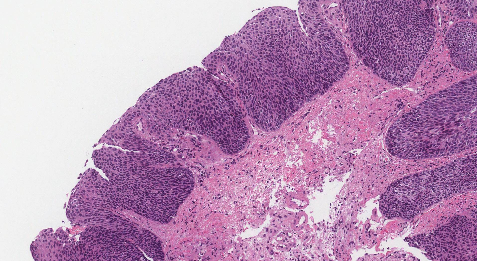 This image shows HPV associated dysplasia of the larynx viewed under the microscope.