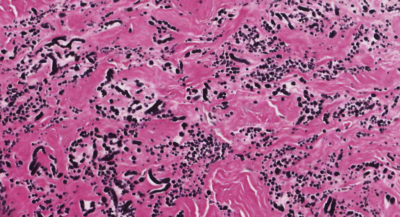 This image shows an elastofibroma viewed through a microscope. A special stain has been used to turn the elastic fibers black.