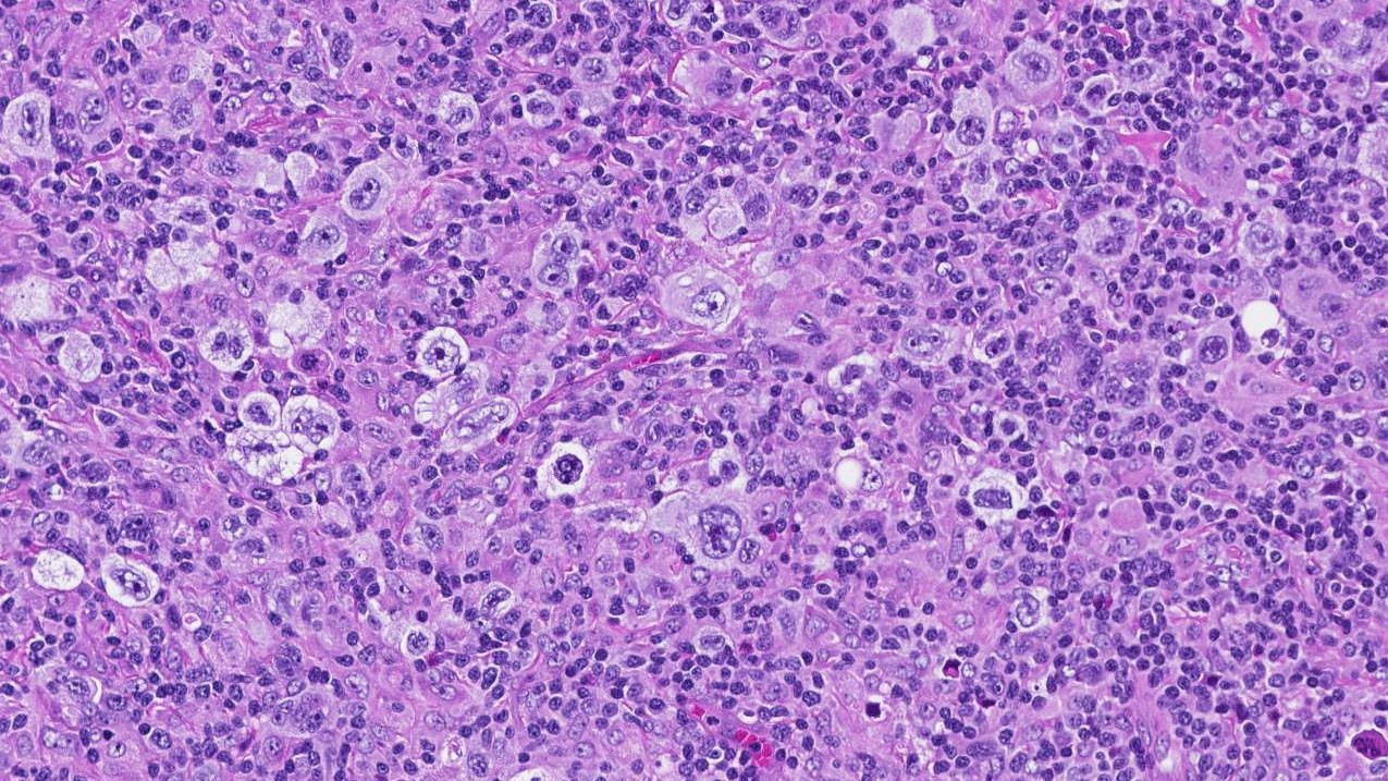 ランニング中の怪我について