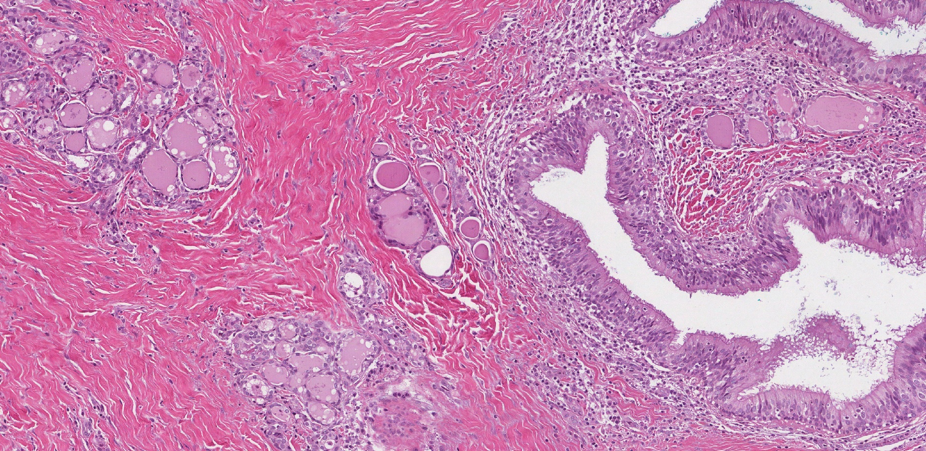 This image shows a thyroglossal duct cyst viewed under the microscope. The cyst is lined by respiratory type epithelium (right) with underlying thyroid tissue (left).