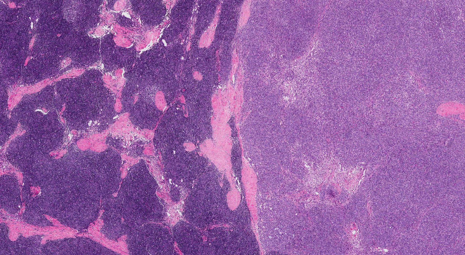 type AB thymoma