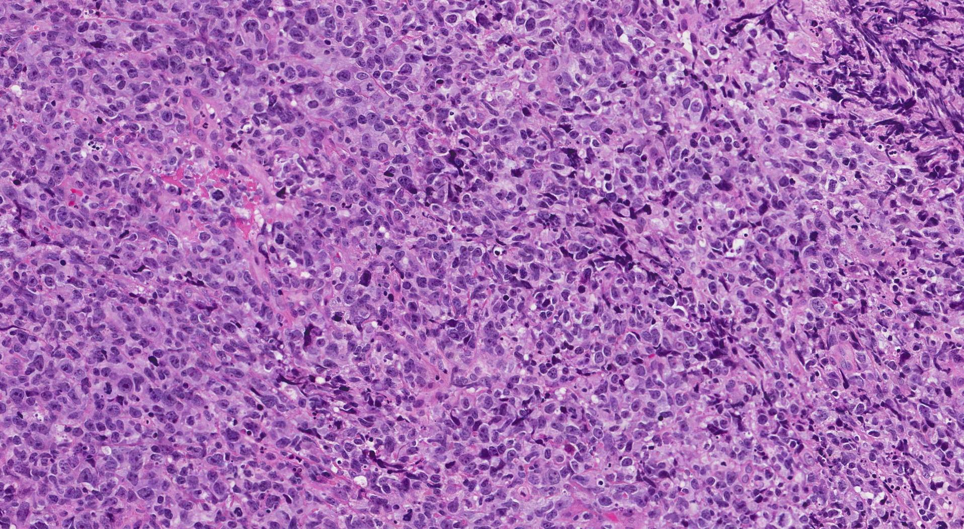 This image shows a typical example of non-keratinizing squamous cell carcinoma viewed under the microscope.