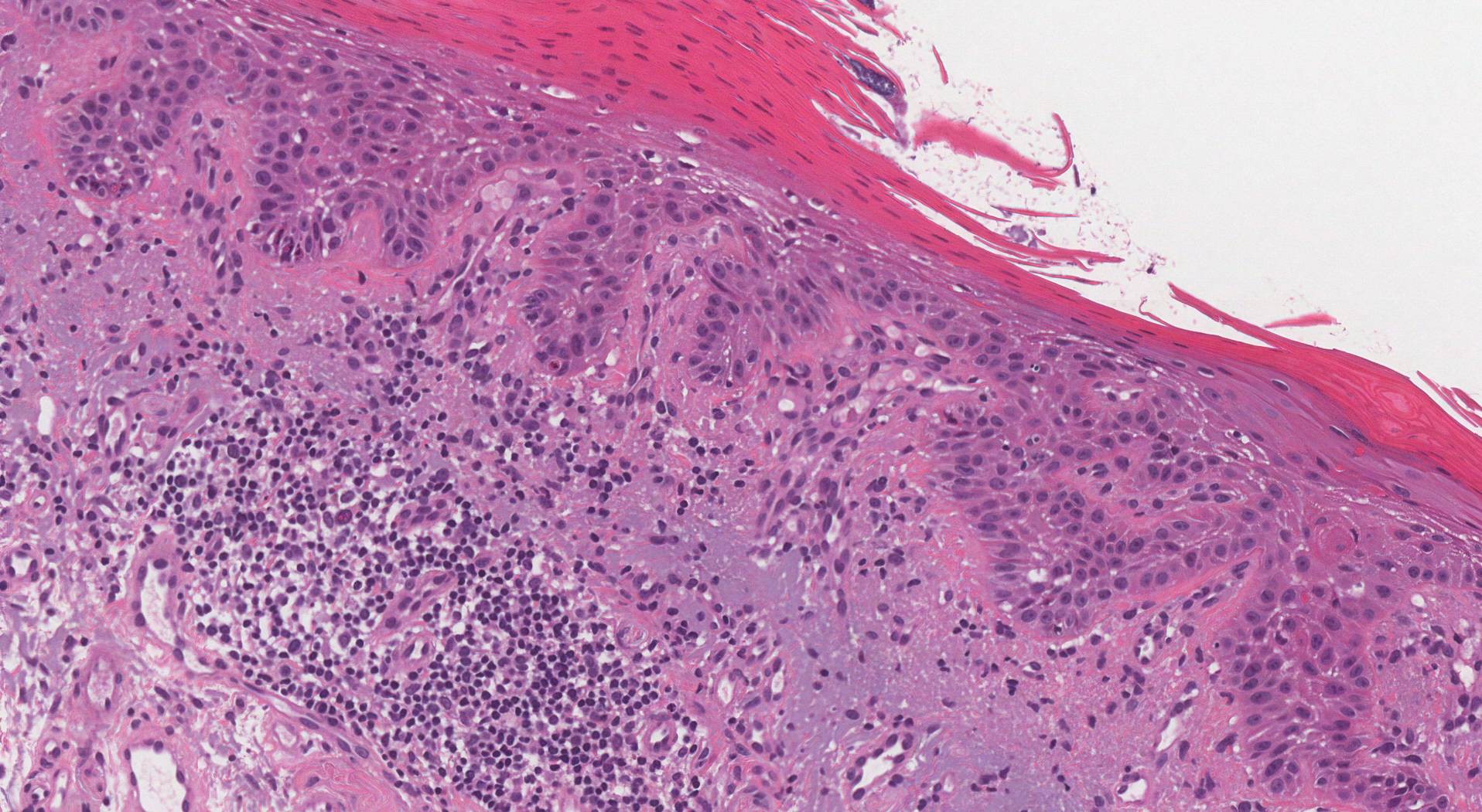 Actinic cheilitis