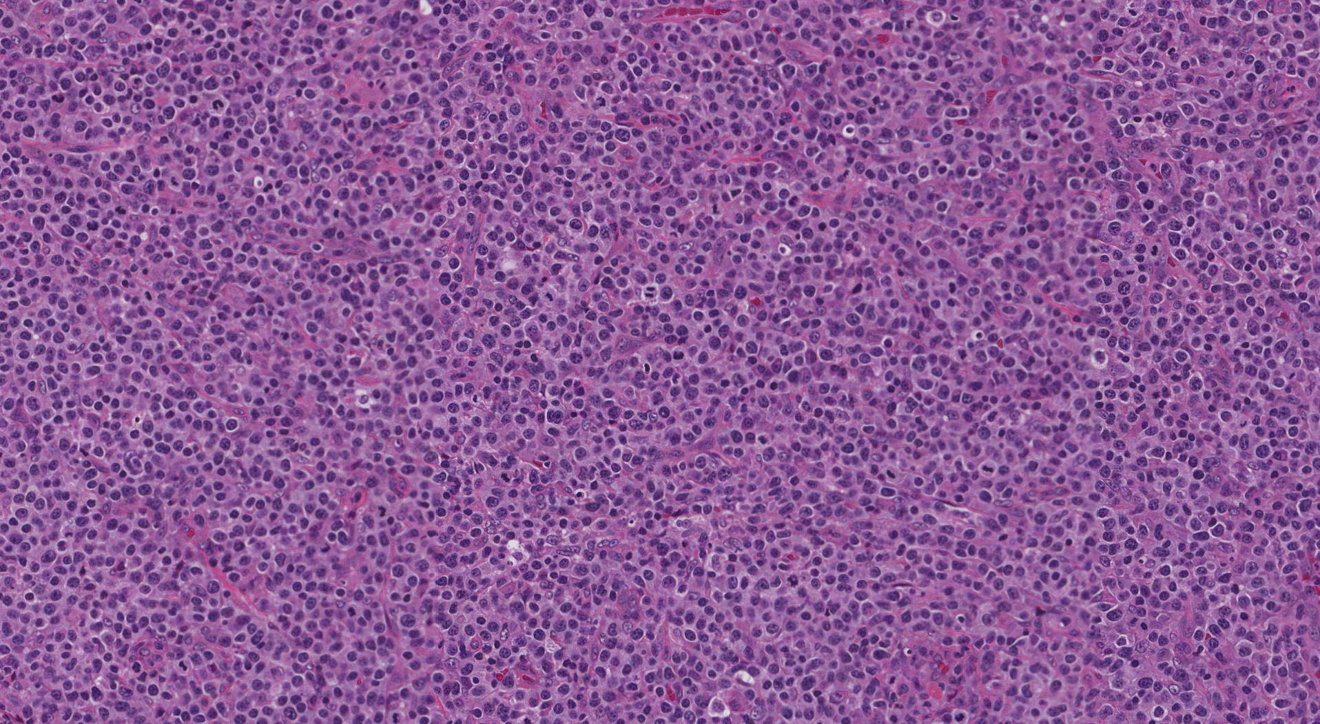 Peripheral T cell lymphoma NOS viewed under the microscope.
