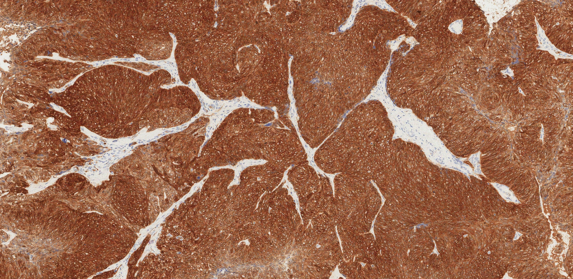 The tumour cells are positive for p16 by immunohistochemistry (brown cells).