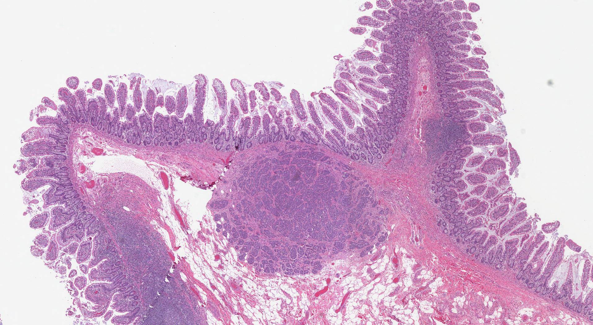 This image shows a well differentiated neuroendocrine tumour in the small intestine.