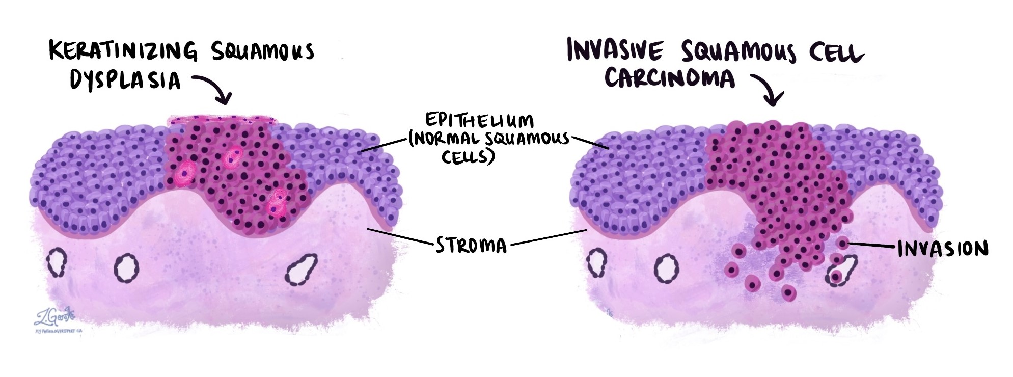 Keratinizing dysplasia