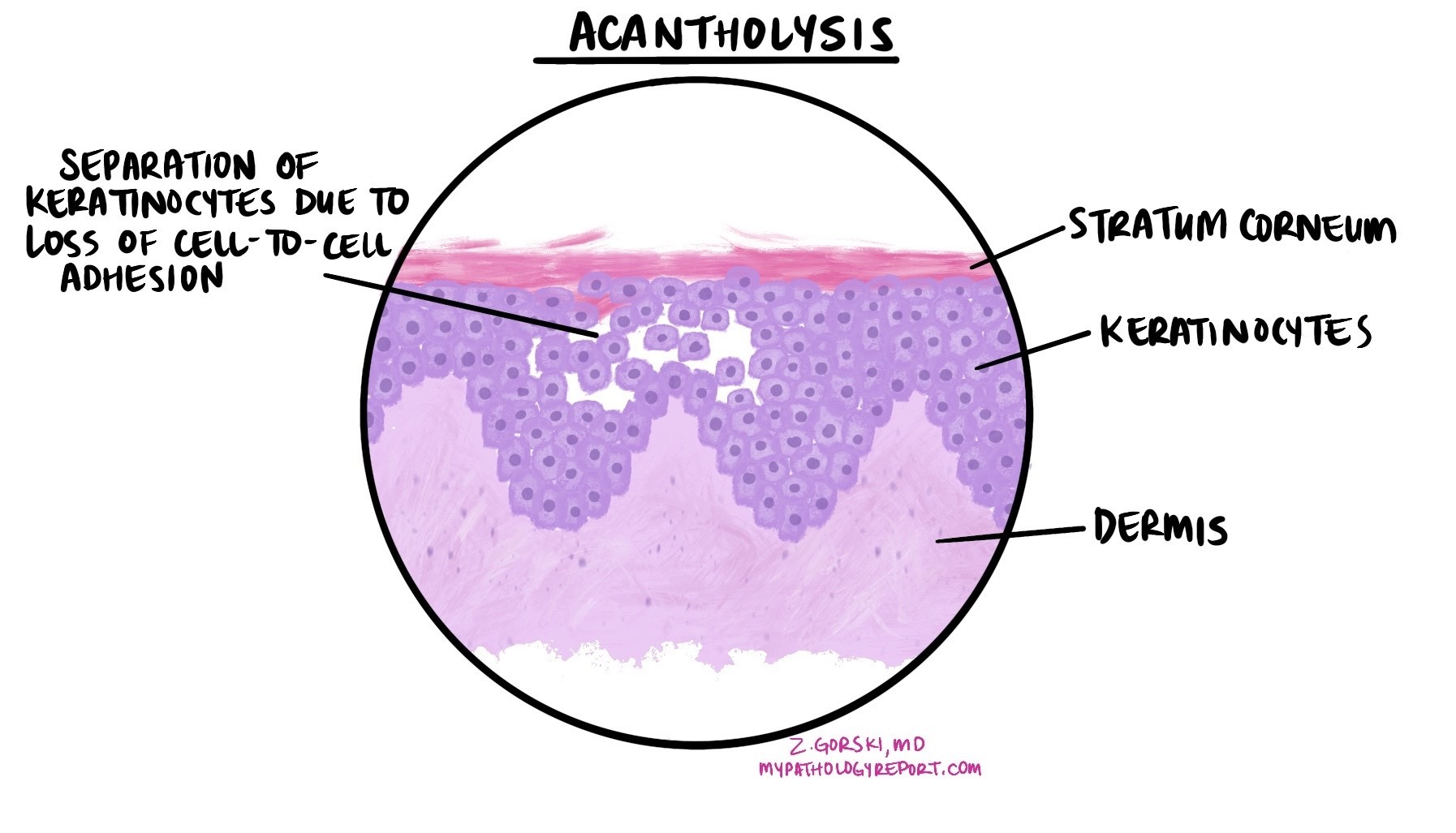 Acantholysis