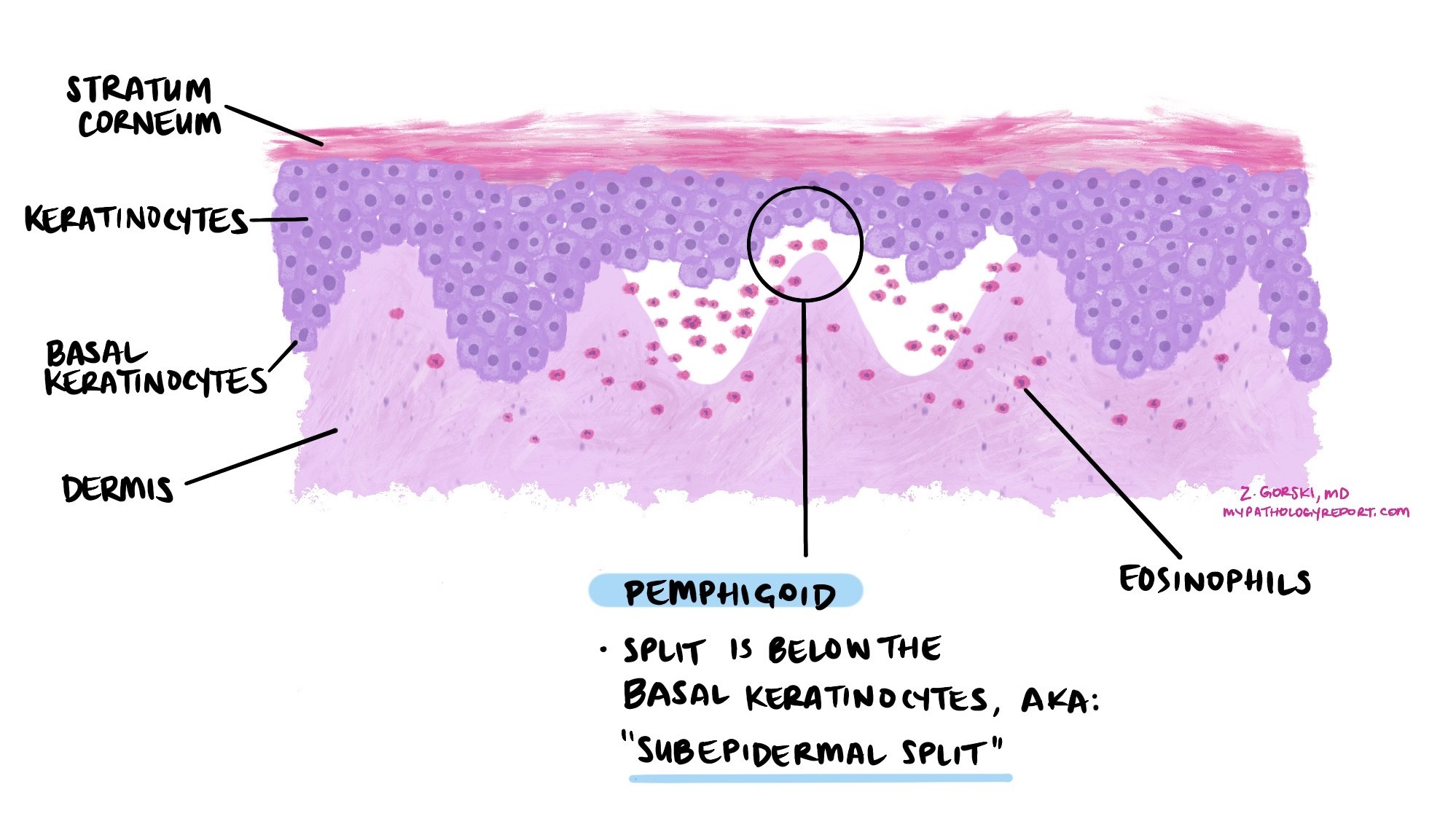 Pemphigoid revised