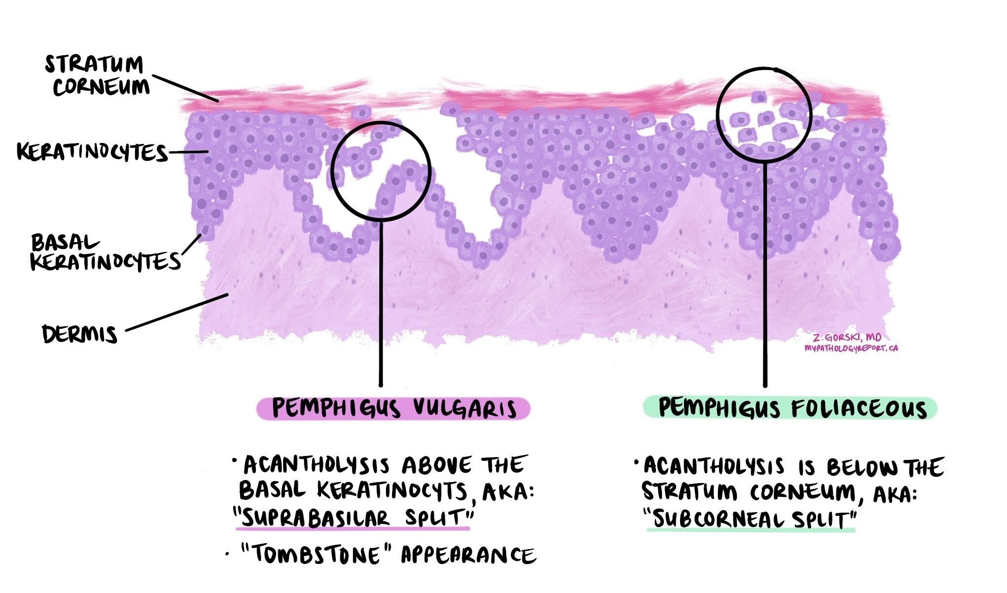 Pemphigus